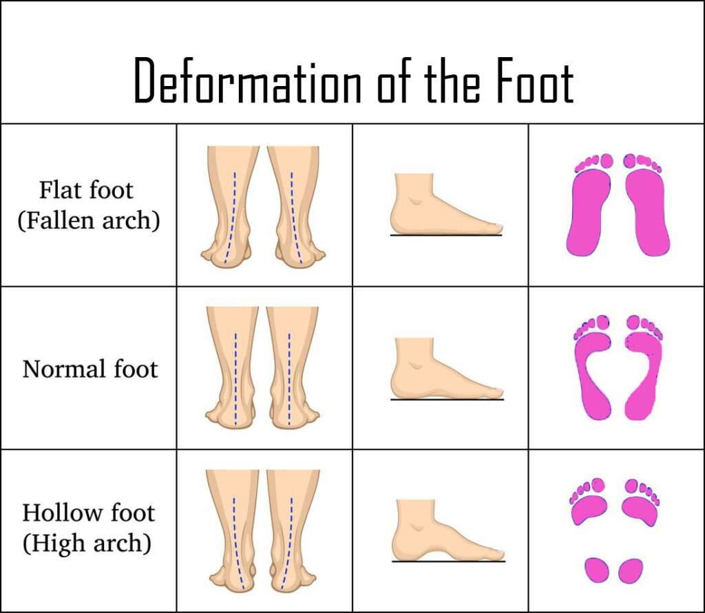 Flat Feet