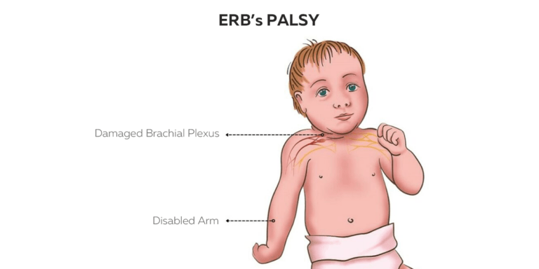 erb's palsy