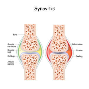 transient synovitis