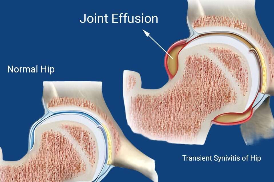 Transient Synovitis