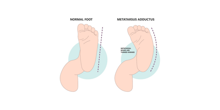 Metatarsus Adductus