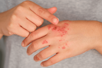 Eczema