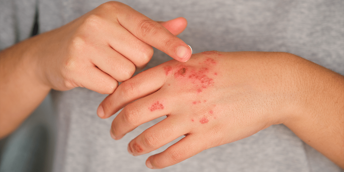 Eczema