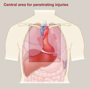 Penetrating Chest Injuries