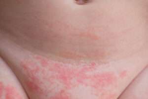 Diaper Rash Causes