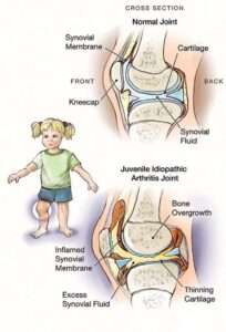  Juvenile Rheumatoid Arthritis