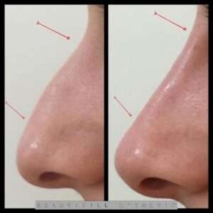 What is rhinoplasty?