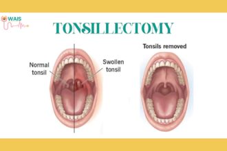 tonsil surgery in childern