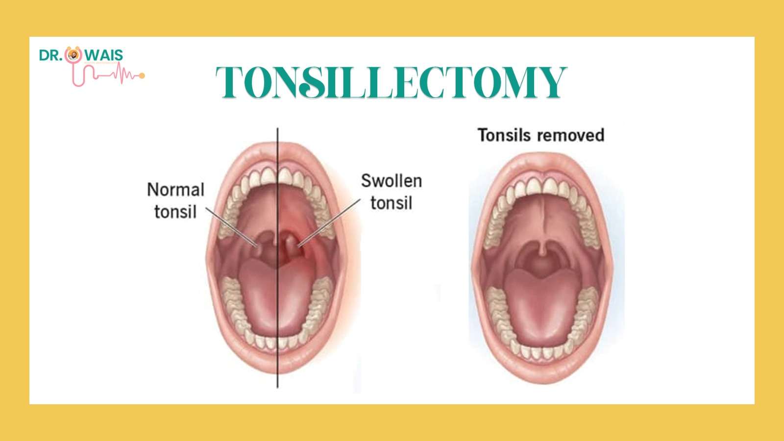 tonsil surgery in childern