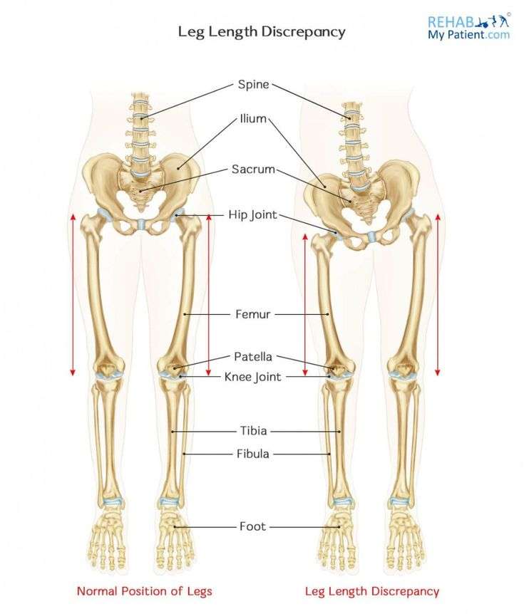 Leg length discrepancy