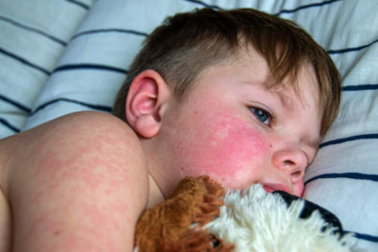 Chickenpox infection in children