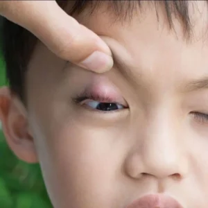 Chalazion in Children