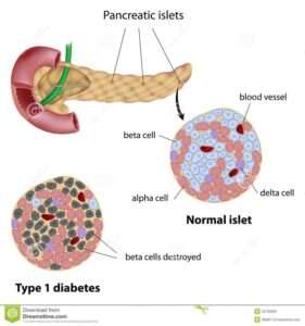 insulin for Type-1 Diabetes