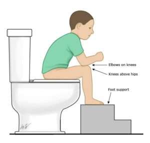 CONSTIPATION IN CHILDREN