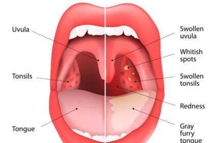 Tonsillitis symptoms