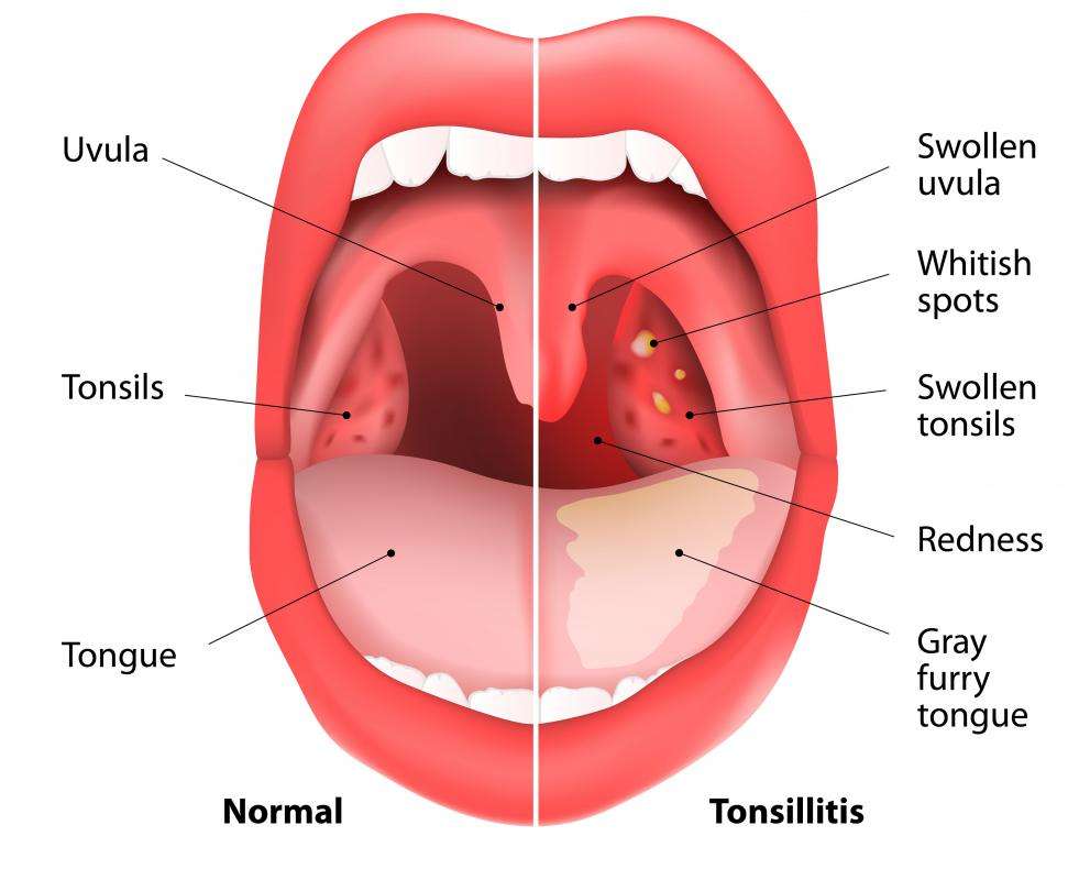 Tonsillitis symptoms