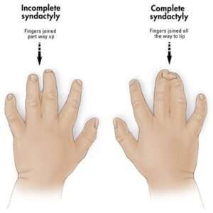 SYNDACTYLY OR WEBBED FINGERS?