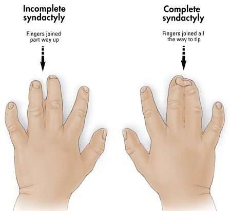 SYNDACTYLY OR WEBBED FINGERS?