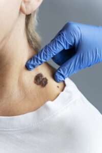 skin cancer screening