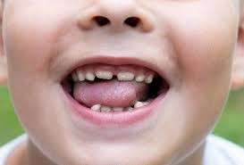 White Spots on Children’s Teeth