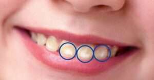 White Spots on Children’s Teeth