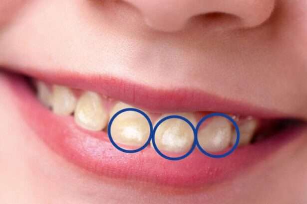 White Spots on Children’s Teeth