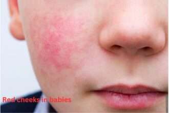 Red Cheeks in Babies