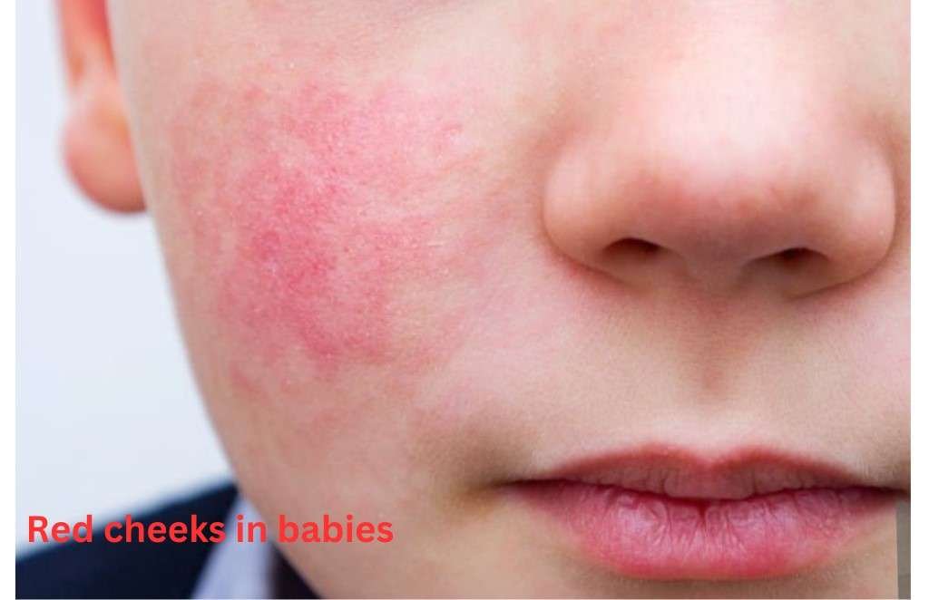 Red Cheeks In Babies Causes Symptoms And Treatments Red Cheeks In Babies Causes Symptoms And Treatments