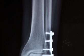 Stress Fracture