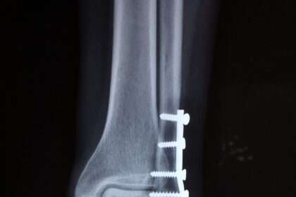 Stress Fracture