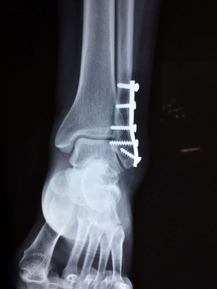 Stress Fracture